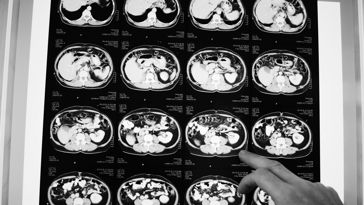 تصویربرداری مغزی از قشر پیشپیشانی که نقش کلیدی در کنترل توجه و تکانهها در افراد مبتلا به ADHD دارد